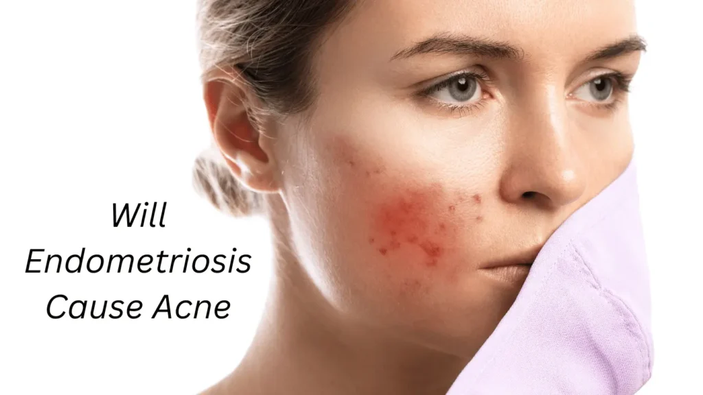 Woman showing acne breakout on cheek possibly linked to endometriosis.